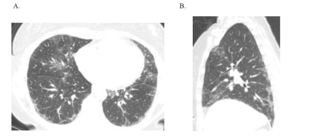 Diagnosis and Management of Patients with Connective Tissue Disease-related Fibrosing Interstitial Lung Diseases.