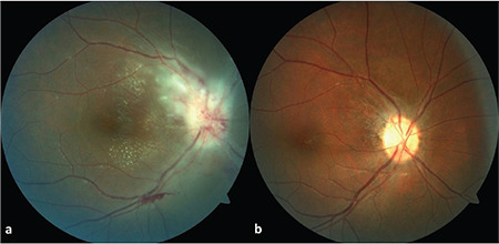 A Case Series of Cat-Scratch Disease with Ocular Manifestations: Clinical Findings and Treatment Approach.