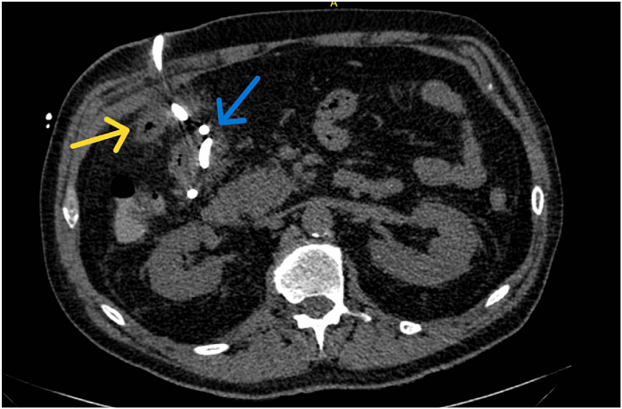 Abscess drain migration into the colon following laparoscopic cholecystectomy