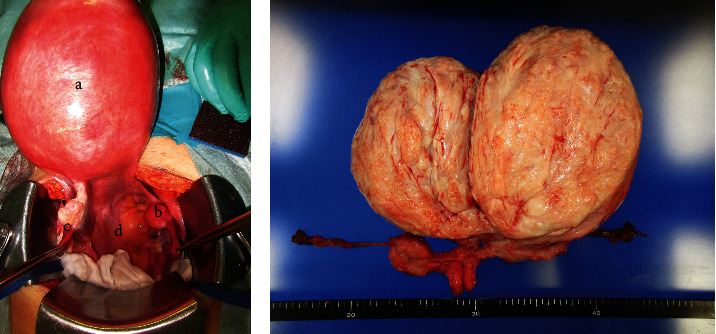 Huge Leiomyomas Arising from Bilateral Uterine Remnants in a Mayer-Rokitansky-Küster-Hauser Syndrome Patient with Coexisting Myotonic Dystrophy Type 1: A Case Report and Literature Review.