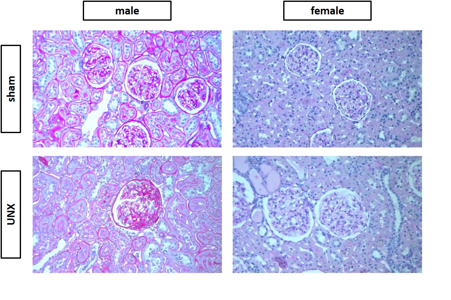 Sex differences in long-term kidney fibrosis following neonatal nephron loss during ongoing nephrogenesis.