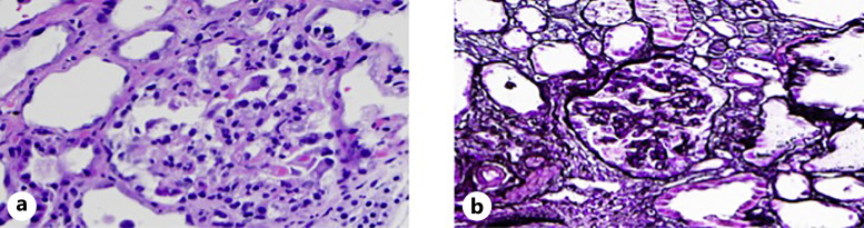 Viral Glomerulopathy.