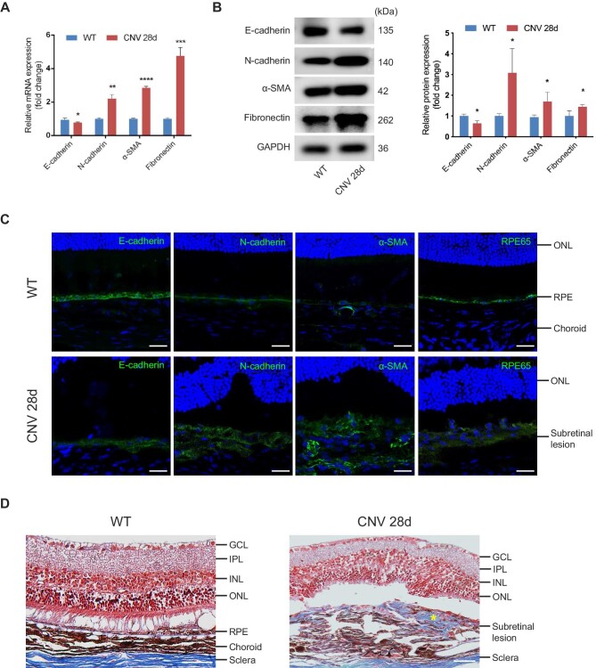 METTL3-mediated m6A modification of HMGA2 mRNA promotes subretinal fibrosis and epithelial-mesenchymal transition.