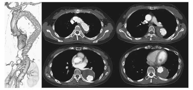 Staged hybrid repair for a patient with chronic type B aortic dissection.