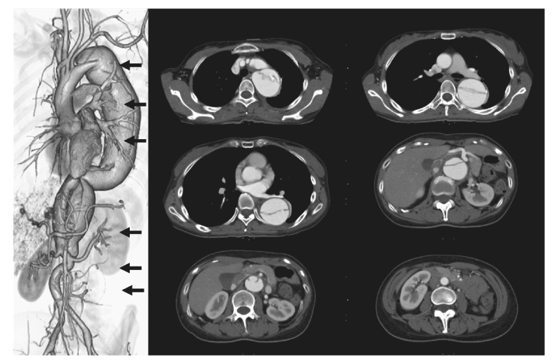 Staged hybrid repair for a patient with chronic type B aortic dissection.