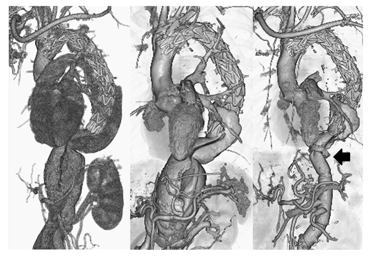 Staged hybrid repair for a patient with chronic type B aortic dissection.