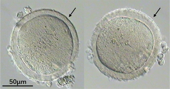 Compare Two Kinds of Recurrent MI-Arrest Oocytes.