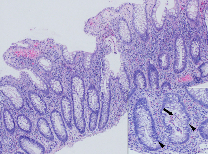 Hypereosinophilic Syndrome with Pulmonary Involvement in Ulcerative Colitis.