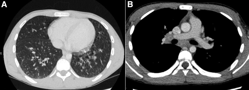 Hypereosinophilic Syndrome with Pulmonary Involvement in Ulcerative Colitis.