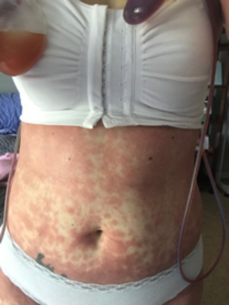 Propofol Induced Subacute Cutaneous Lupus Erythematosus: A Case Report.