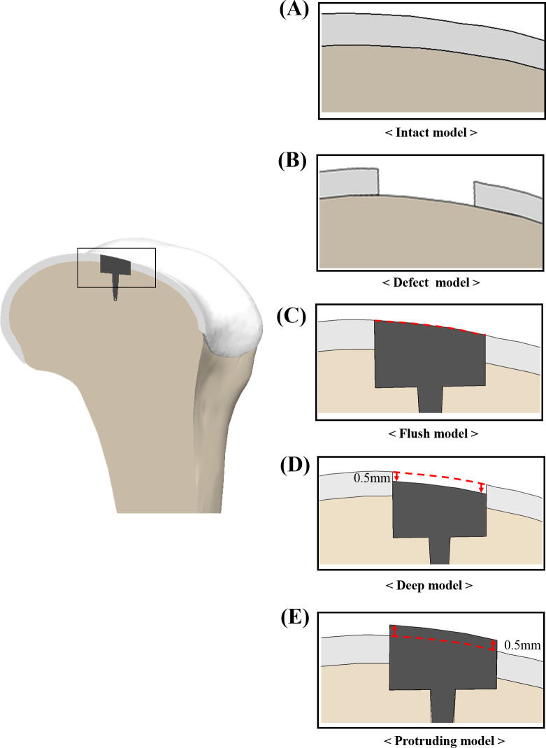 Effect of surface matching mismatch of focal knee articular prosthetic on tibiofemoral contact stress using finite element analysis.