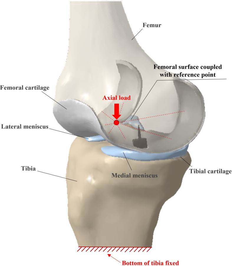 Effect of surface matching mismatch of focal knee articular prosthetic on tibiofemoral contact stress using finite element analysis.