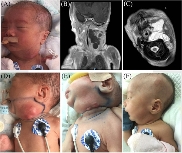 Rapid response with good toleration of sirolimus for life-threatening neonatal lymphatic malformations.