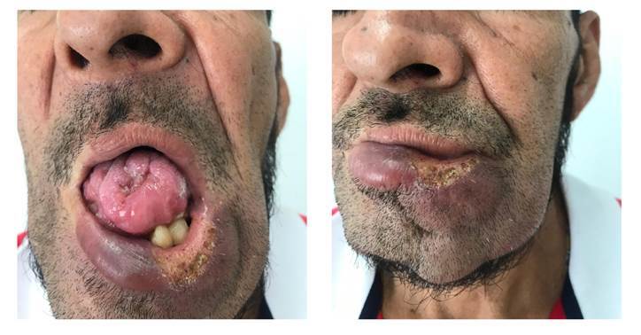 Pseudoepitheliomatous hyperplasia: Squamous cell carcinoma versus oral paracoccidioidomycosis, a case from a dermatological perspective