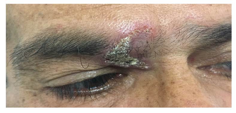 Pseudoepitheliomatous hyperplasia: Squamous cell carcinoma versus oral paracoccidioidomycosis, a case from a dermatological perspective