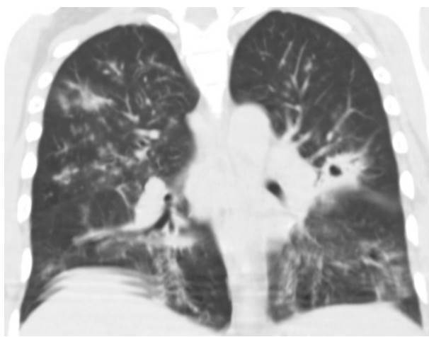 Meningeal cryptococcosis and SARS-CoV-2 infection in people living with HIV/AIDS.