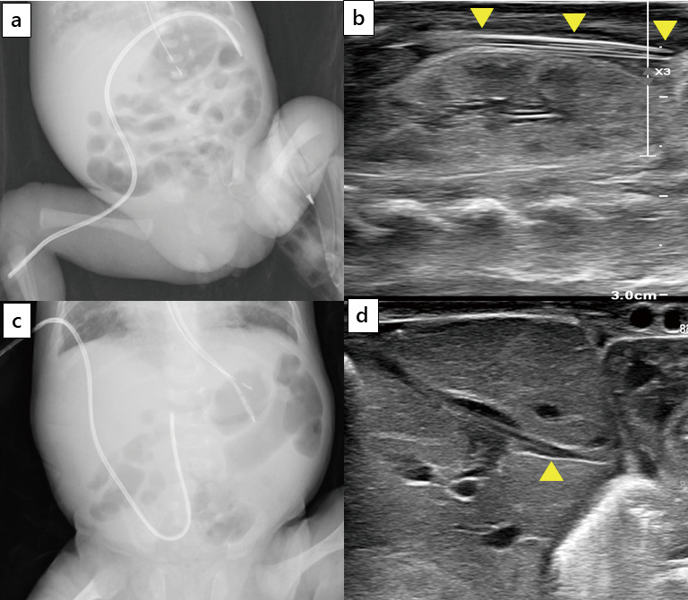 Vascular perforation of umbilical venous catheter and awaiting it to be shallow.