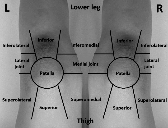 Mapping the course to recovery: a prospective study on the anatomic distribution of early postoperative pain after total knee arthroplasty.