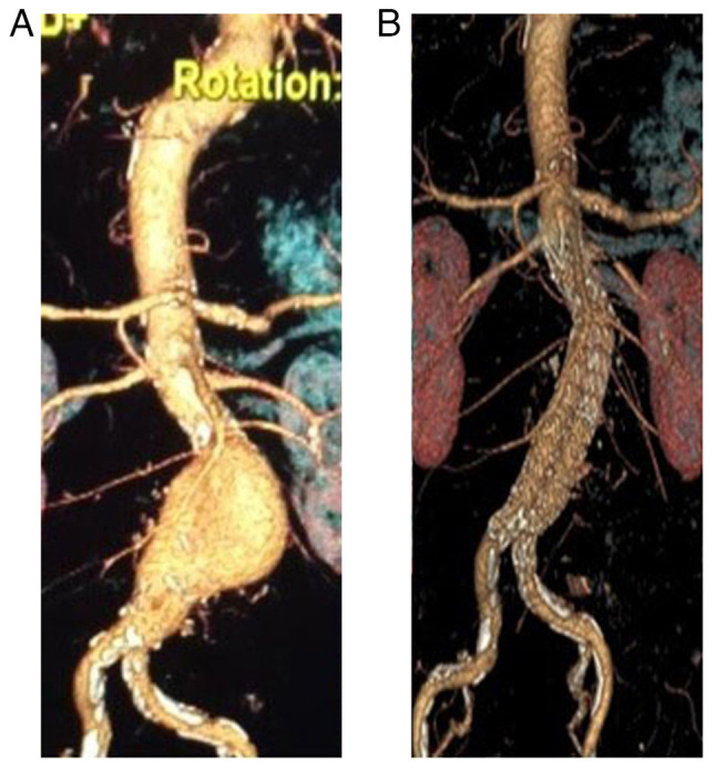 Abdominal aortic aneurysm: A case report.