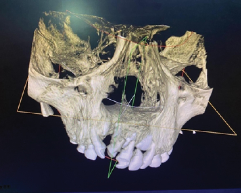 Consequence of Synthetic Bone Substitute Used for Alveolar Cleft Graft Reconstruction (Preliminary Clinical Study).