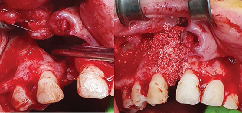 Consequence of Synthetic Bone Substitute Used for Alveolar Cleft Graft Reconstruction (Preliminary Clinical Study).