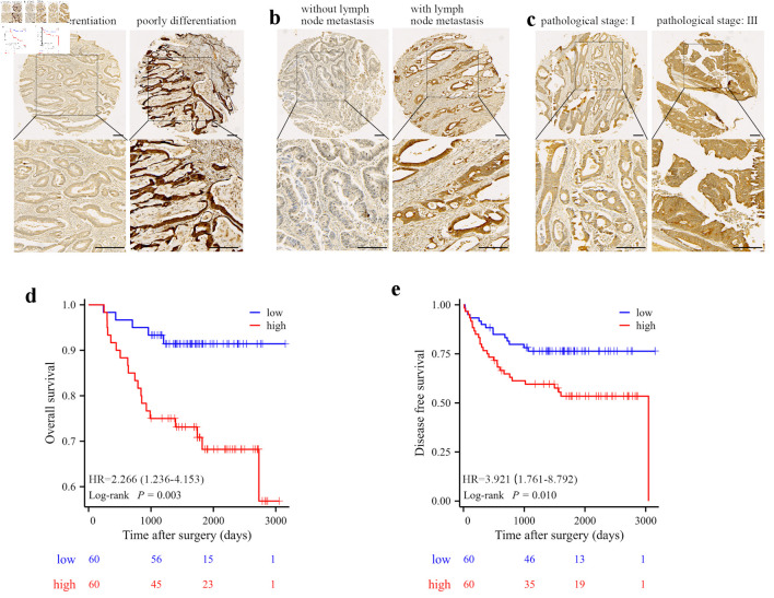 High Expression of F-Box Protein 43 Is Associated With Poor Prognosis and Adjuvant Chemotherapy Resistance in Colorectal Cancer.