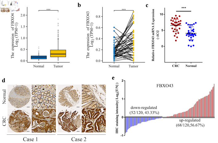 High Expression of F-Box Protein 43 Is Associated With Poor Prognosis and Adjuvant Chemotherapy Resistance in Colorectal Cancer.