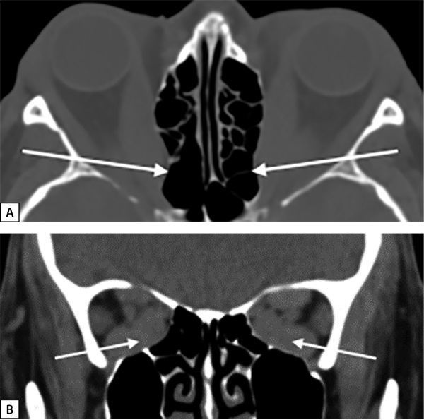 [An integrated approach to the treatment of pretibial myxedema based on pulse therapy with prednisolone and electrical neuromyostimulation (FREMS-therapy) in a patient with Graves' disease and thyroid eye disease].