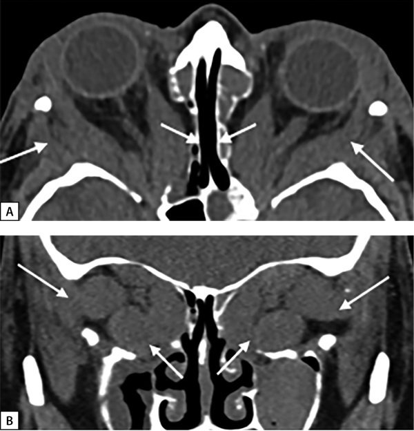 [An integrated approach to the treatment of pretibial myxedema based on pulse therapy with prednisolone and electrical neuromyostimulation (FREMS-therapy) in a patient with Graves' disease and thyroid eye disease].