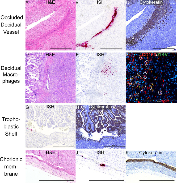 Vertical transmission of African-lineage Zika virus through the fetal membranes in a rhesus macaque (Macaca mulatta) model.