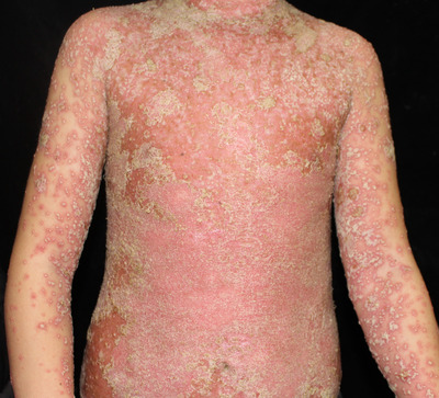 The update of treatment strategies in pediatrics with generalized pustular psoriasis in China.