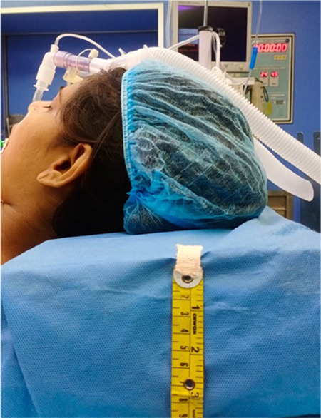 Nasogastric Tube Insertion in Intubated Patients: Comparison of Three Different Positions; Standard Sniffing Position, Additional Flexion of the Neck, and Standard Sniffing Position with Lateral Neck Pressure.