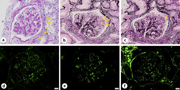 A Case of Rapidly Progressive Diabetic Nephropathy Induced by Osimertinib.