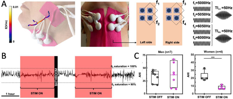 Obstructive sleep apnea improves with non-invasive hypoglossal nerve stimulation using temporal interference.