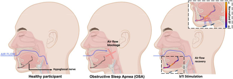 Obstructive sleep apnea improves with non-invasive hypoglossal nerve stimulation using temporal interference.