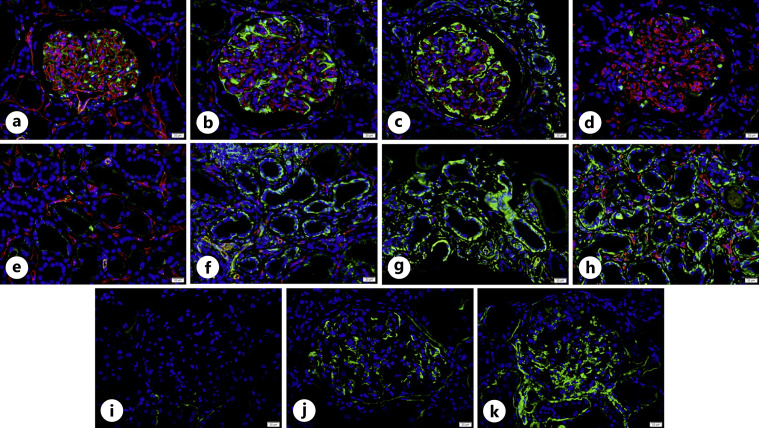 A Case of Rapidly Progressive Diabetic Nephropathy Induced by Osimertinib.