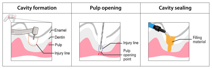 Dental Pulp Stem Cells and Current in vivo Approaches to Study Dental Pulp Stem Cells in Pulp Injury and Regeneration.