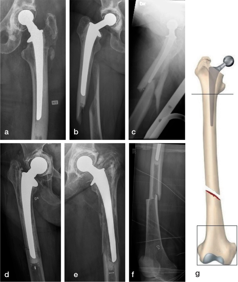 Fracture pattern and risk factors for reoperation after treatment of 156 periprosthetic fractures around an anatomic cemented hip stem.