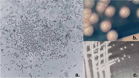 Geotrichosis: fungemia in a patient with acute lymphoblastic leukemia