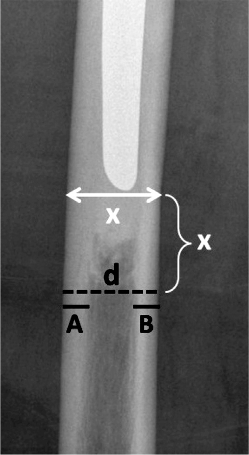 Fracture pattern and risk factors for reoperation after treatment of 156 periprosthetic fractures around an anatomic cemented hip stem.