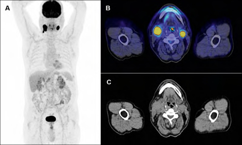 Role of 18F-FDG PET/CT in evaluating lymph node status in patients with head and neck squamous cell carcinoma.