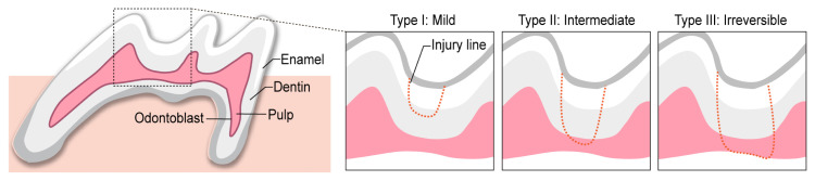 Dental Pulp Stem Cells and Current in vivo Approaches to Study Dental Pulp Stem Cells in Pulp Injury and Regeneration.