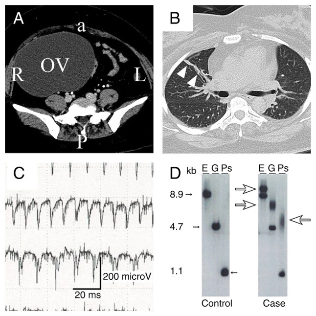 Undiagnosed myotonic dystrophy: A case report and literature review.