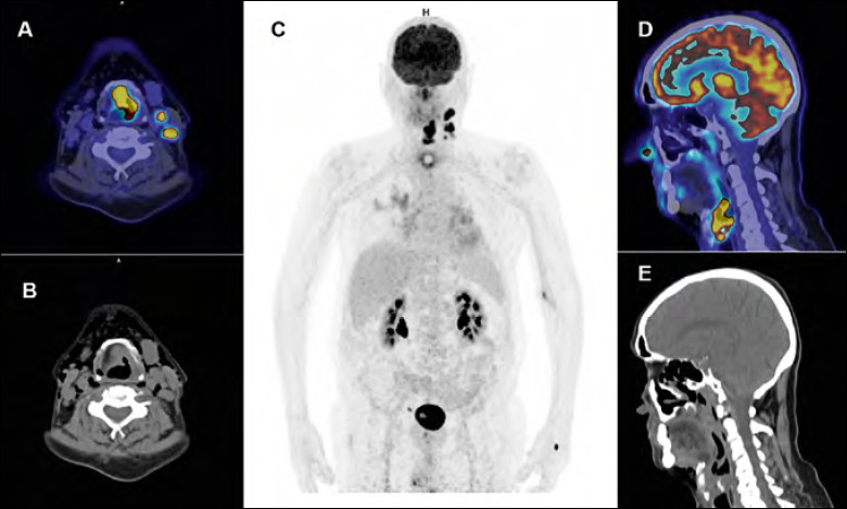 Role of 18F-FDG PET/CT in evaluating lymph node status in patients with head and neck squamous cell carcinoma.