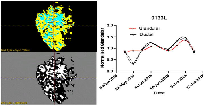 Low frequency 3D transmission ultrasound tomography: technical details and clinical implications