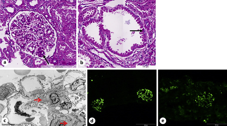 A Novel Mutation of UMOD in a Chinese Family with IgA Nephropathy: A Case Report.