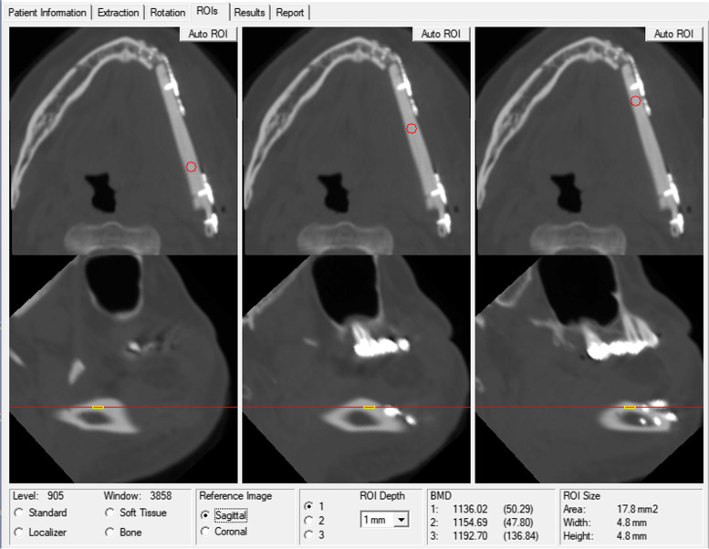 Feasibility analysis of bone density evaluation with Hounsfield unit value after fibula flap reconstruction of jaw defect.