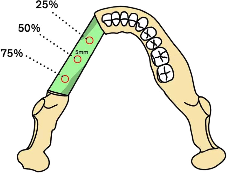 Feasibility analysis of bone density evaluation with Hounsfield unit value after fibula flap reconstruction of jaw defect.