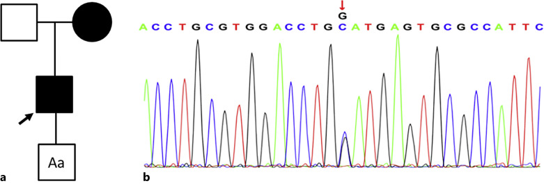 A Novel Mutation of UMOD in a Chinese Family with IgA Nephropathy: A Case Report.