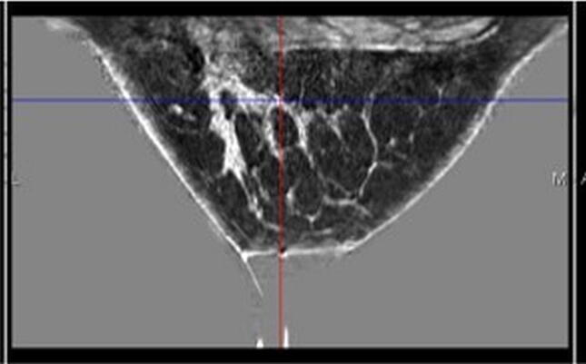 Low frequency 3D transmission ultrasound tomography: technical details and clinical implications